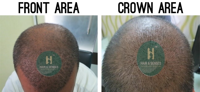 Hair Transplant Case Study